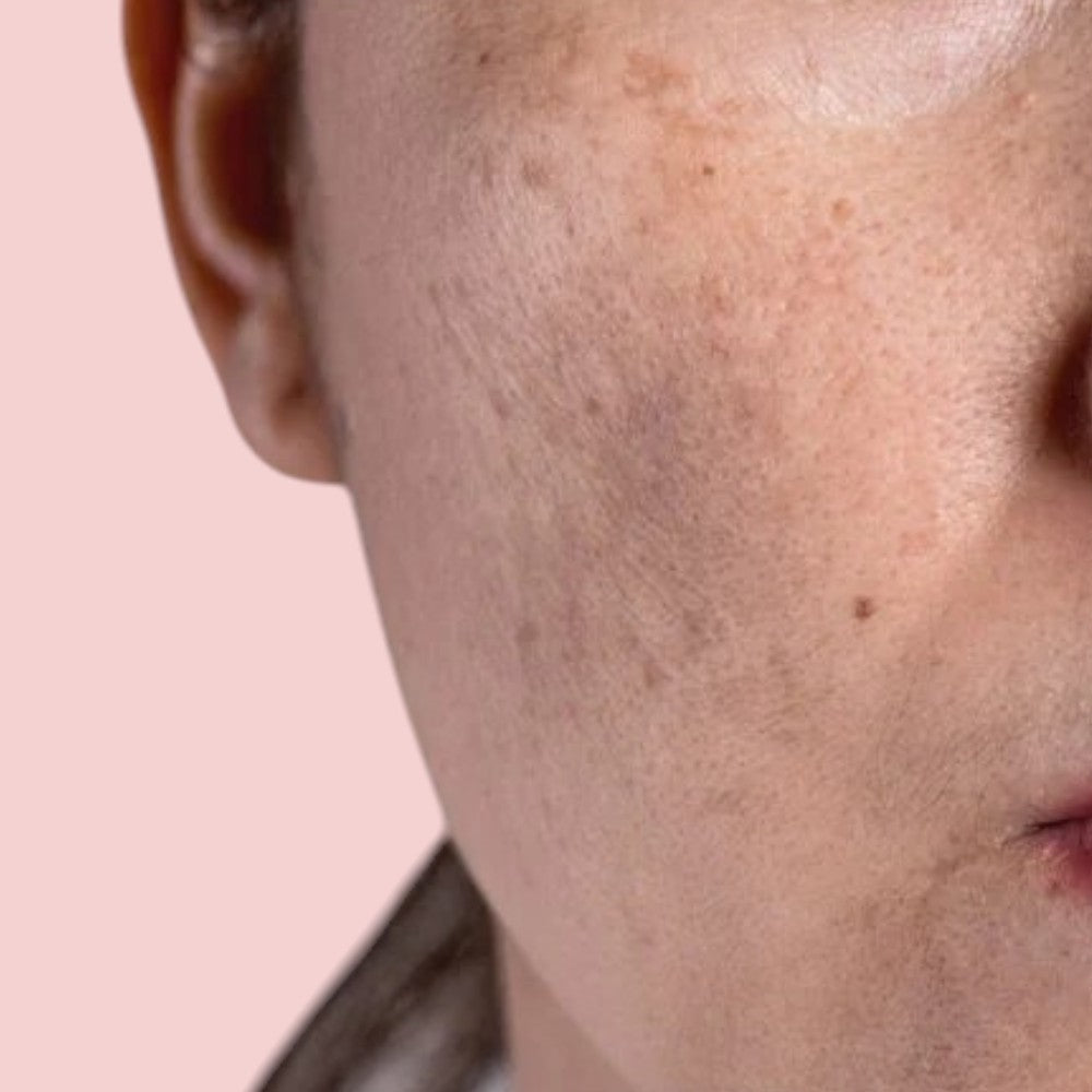 Fleckenalarm! Alles über Pigmentstörungen – und was wirklich hilft!