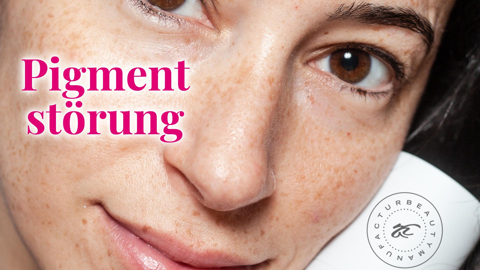 Pigmentstörung