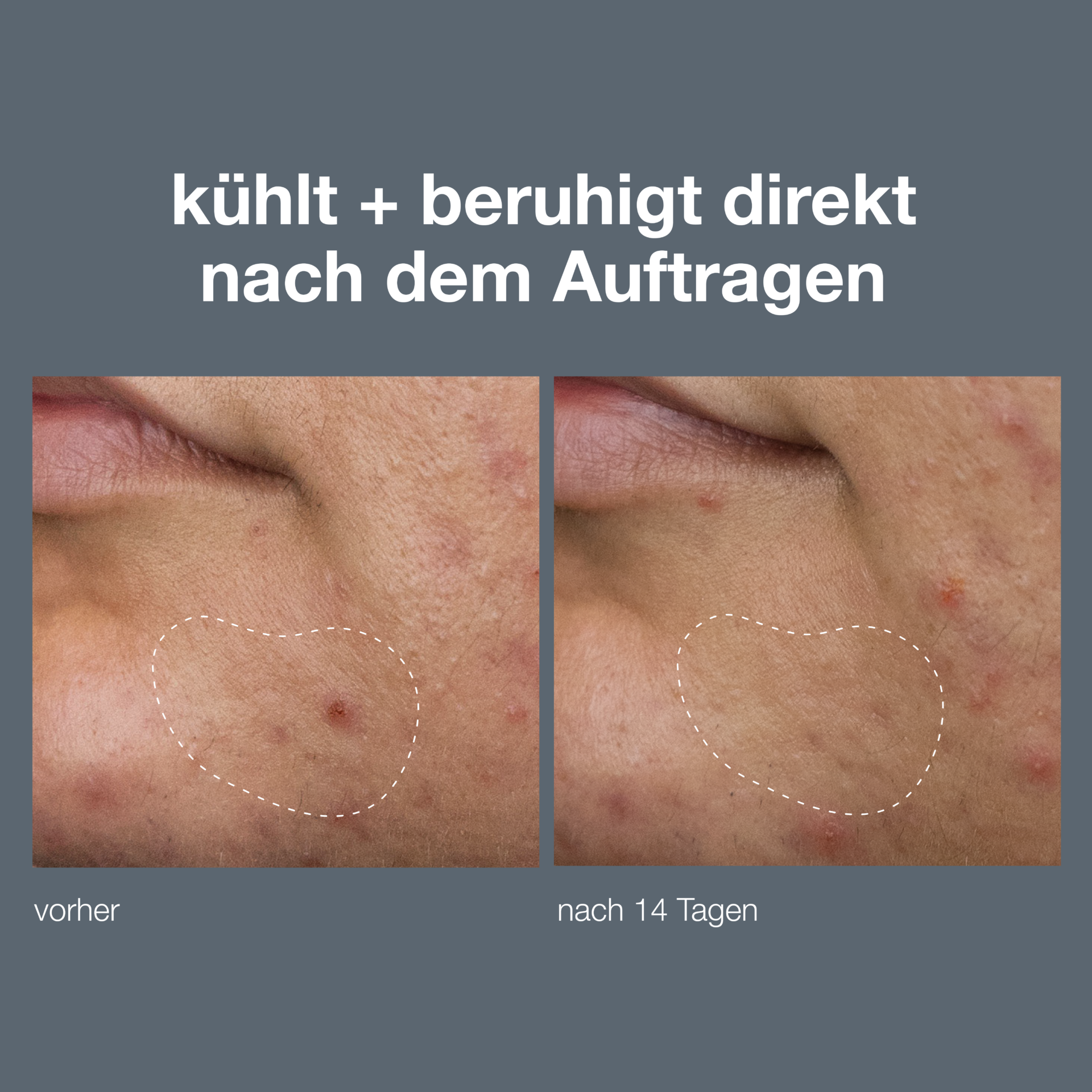 DERMALOGICA Active Clearing Deep Breakout Liquid Patch – verwandelt sich von einer Flüssigkeit in ein transparentes Patch, das die Haut direkt nach dem Auftragen beruhigt und tief in der Haut liegende Entzündungen minimiert., 15ml, Vorher Nachher Vergleich