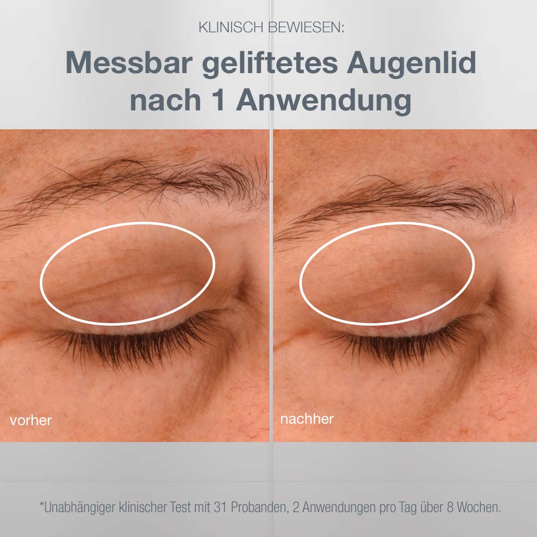 DERMALOGICA Phyto Nature Lifting Eye Cream – Klinisch erwiesen hebt und strafft die reichhaltige Creme das Augenlid sichtbar nach nur 1 Anwendung., 15ml, vorher-nachher