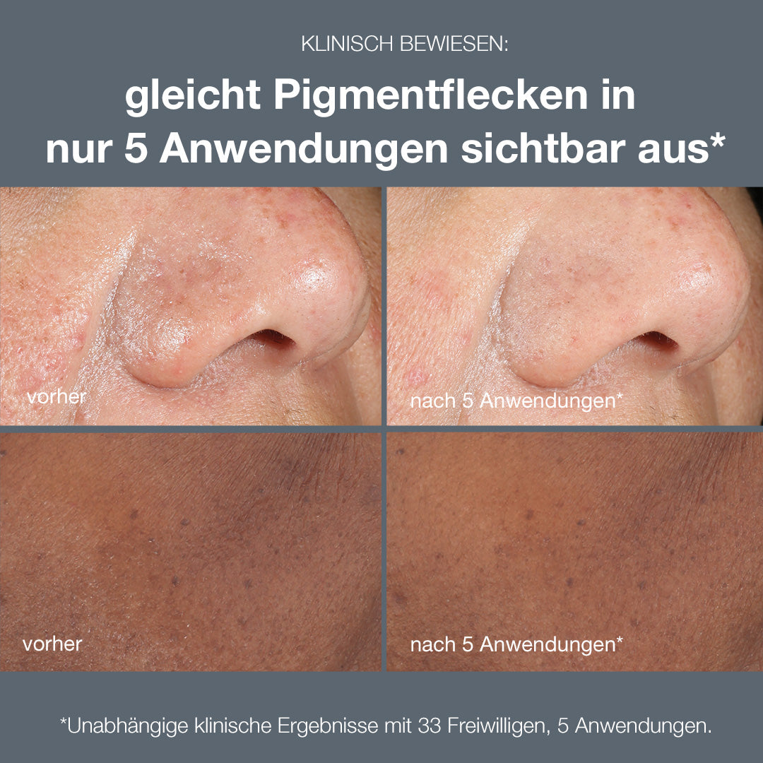DERMALOGICA PowerBright dark spot peel – effektive Behandlung gegen Pigmentflecken für zu Hause. Es hilft, oberflächliche Hyperpigmentierung sichtbar zu beseitigen - einschließlich UV-bedingter dunkler Flecken, 50ml, vorher-nachher