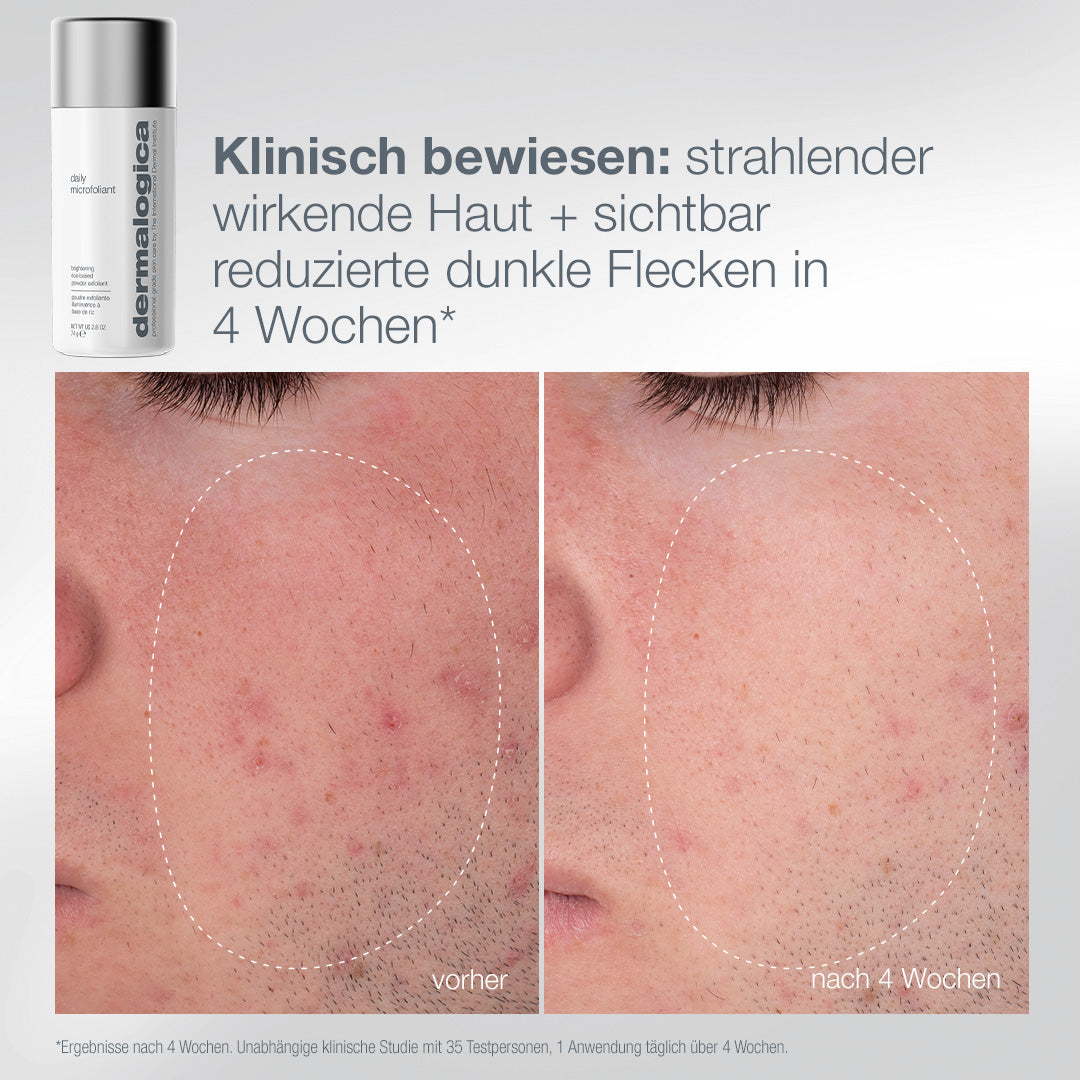 DERMALOGICA Pro Ritual: Exfoliate + Glow – Daily Microfoliant Set, -, Daily Microfoliant vorher nachher