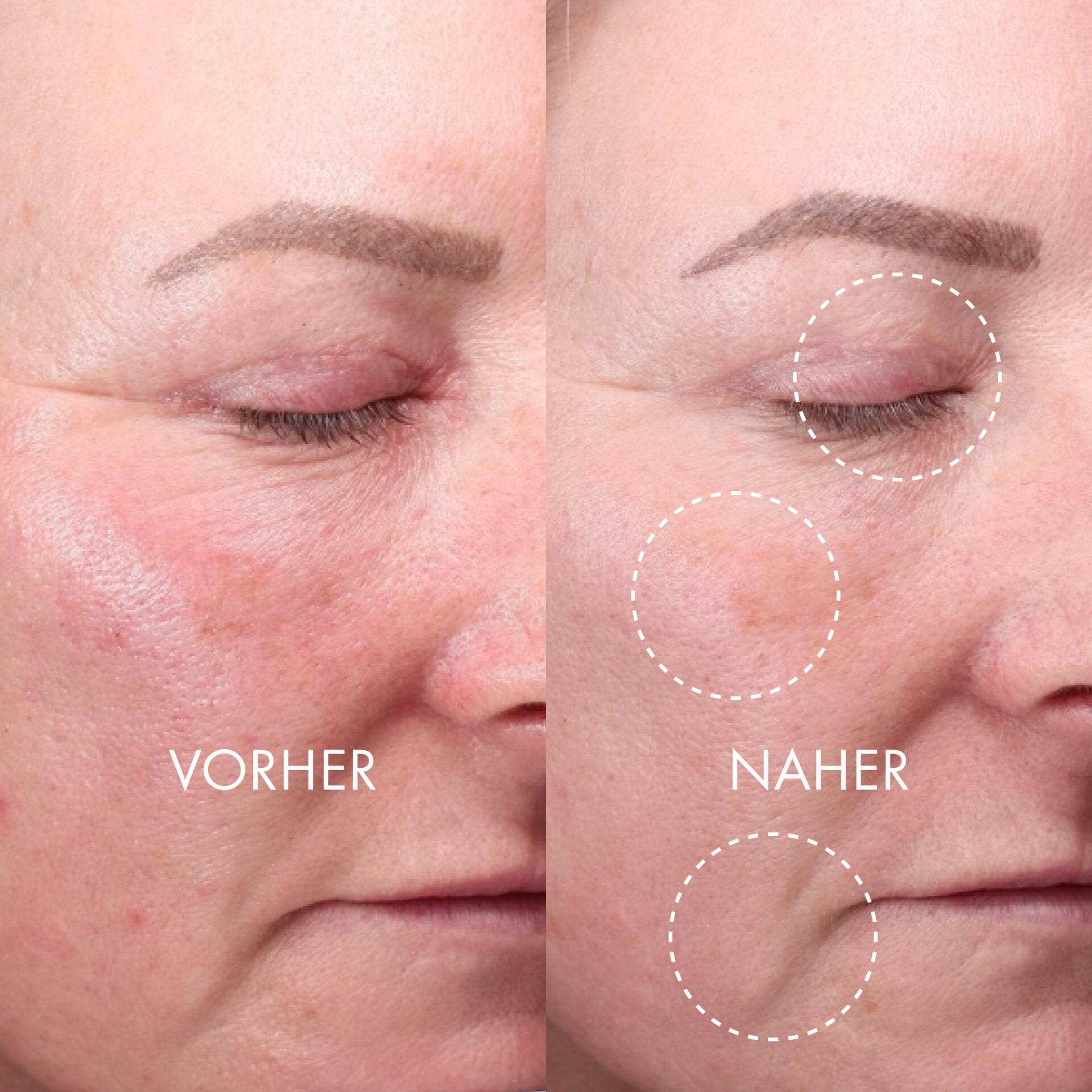 QMS Derma Expert LED Light Treatment – Maske zur Hautverjüngung, ., vorher nachher Vergleich Gesicht Frau
